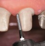 Finishing the preparation: the tooth stump is finished with the fine grit cylindrical diamond (FG 3614B)