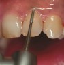 Removal of subgingival concrements in closed treatment with instrument RA 415