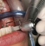 In the following stage the operator remove enamel progressively with Intensiv Ortho-Strips OS90, 90µm. For this procedure the operator can lock the strip in a precise position pressing a button behind Swingle’s head. 