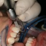 Calibrated enamel removal with Ortho-Strips OS90, 90µm.For this type of procedure the operator can lock the strip pressing a button behind Swingle’s head. 