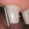 Preparation of chamfer on tooth 11: The circular chamfer is prepared with the long cylindrical diamond (FG 8040)