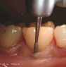 Removal of subgingival concrements and plaque in posterior tooth with instrument RA 740