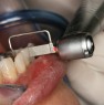 In the next step the operator use again Ortho-Strips OS40 to refine the treated area before polishing..
