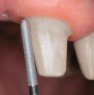 Finishing the preparation: the tooth stump is finished with the fine grit, cylindrical diamond (FG 3040B)