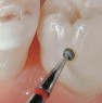 Preparation of the palatal micro cavity with instrument FG 4610