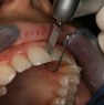 After this stage the operator utilize Ortho-Strips OS40, 40µm, in order to proceed gradually to finish the treated area.