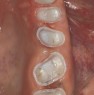 Shoulder preparation: defect-oriented crown preparations on molars and premolars after finishing for adhesive attachment of full ceramic Cerec crowns