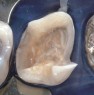 Defect-oriented partial crown preparation to be treated with a Cerec restoration