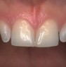 Veneer preparations on the lateral incisor teeth without inclusion of the incisal edges