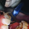 Creating additional space by interproximal enamel reduction (IPR)