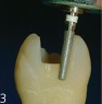 FG 3427/3425: finishing of interproximal and cervical margins