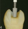 FG 3413R: finishing of the occlusal surface