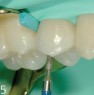 FG 8212S: opening of the cavity for direct restorations