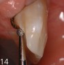 Preparation of a cingulum support in the enamel with ball instrument FG 201