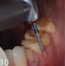 Defect-oriented overlay (tabletop) preparation on a patient with dentition damaged by erosion and abrasion, rough preparation with preparation instrument FG 8526, occlusal preparation with football instrument FG 250