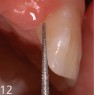 Definition of a mesial and distal groove in the enamel in the desired direction of insertion, slightly palatal to the future contact point, with separation instrument FG D3