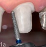 Stufenpräparation an Zahn 21: Die zirkuläre Stufe wird mit dem konischen Diamant (FG 8422) mit planer Stirnseite angelegt. Die Stufenbreite beträgt ca. 0.8mm