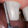 Hohlkehlpräparation an Zahn 11: Die zirkuläre Hohlkehle wird mit dem zylindrischen Diamant (FG 8040) angelegt