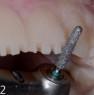 Reduktion der Zahnhartsubstanz am Rillenboden mit Instrument FG 235A C