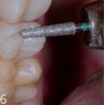 Reduction of tooth substance at the bottom of the grooves with instrument 235A C