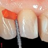 Insertion of an interdental wedge cervically and separation with instrument FG D16