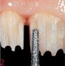Preparation of diagnostic grooves with instrument FG 237 and axial circular and incisal reduction with instruments FG 235, 237 or 240