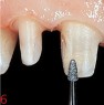 Finishing or incisal contouring as well as cervical chamfer with instrument FG 274GB