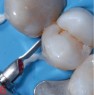 Contouring of the surface below the restored contact point without damaging the adjacent tooth with file PS3