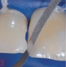 Der nichtdiamantierte Mittelteil erlaubt das Einführen des Strips auch in enge Zahnzwischenräume, ohne Beeinträchtigung des Kontaktpunktes