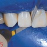 The yellow working part is well-suited for a clinically perfectly polished proximal surface without impairing the contact point