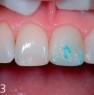 Polierpaste UniglossPaste gut sichtbar auf der restaurierten Zahnfläche