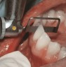 Finishing and prepolishing distally with OS15